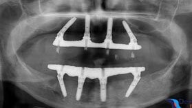 不建議採用 All on 4「全顎四植體支撐固定式長牙橋」的修復方式