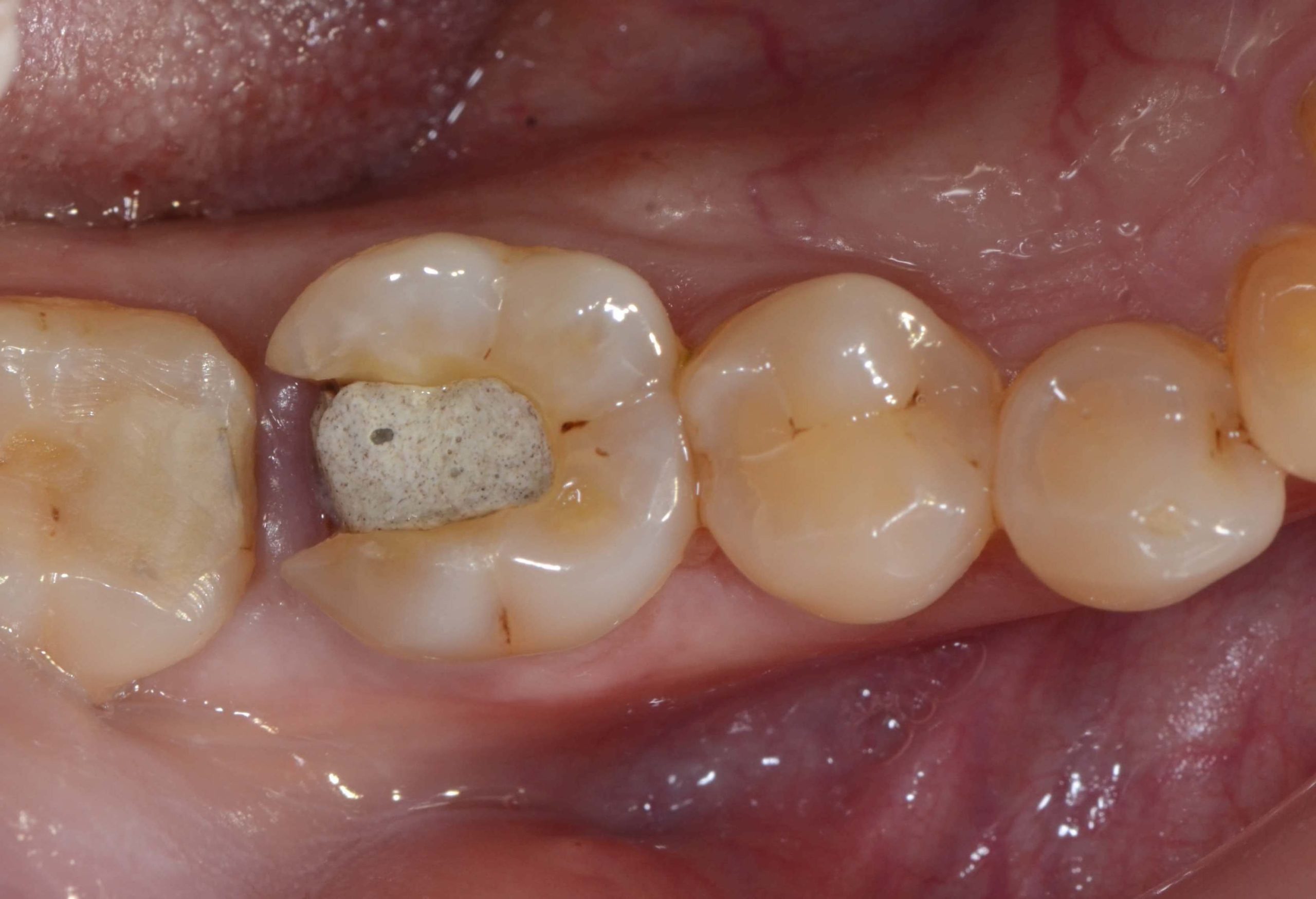 右下顎第一大臼齒深部蛀牙需要拔除