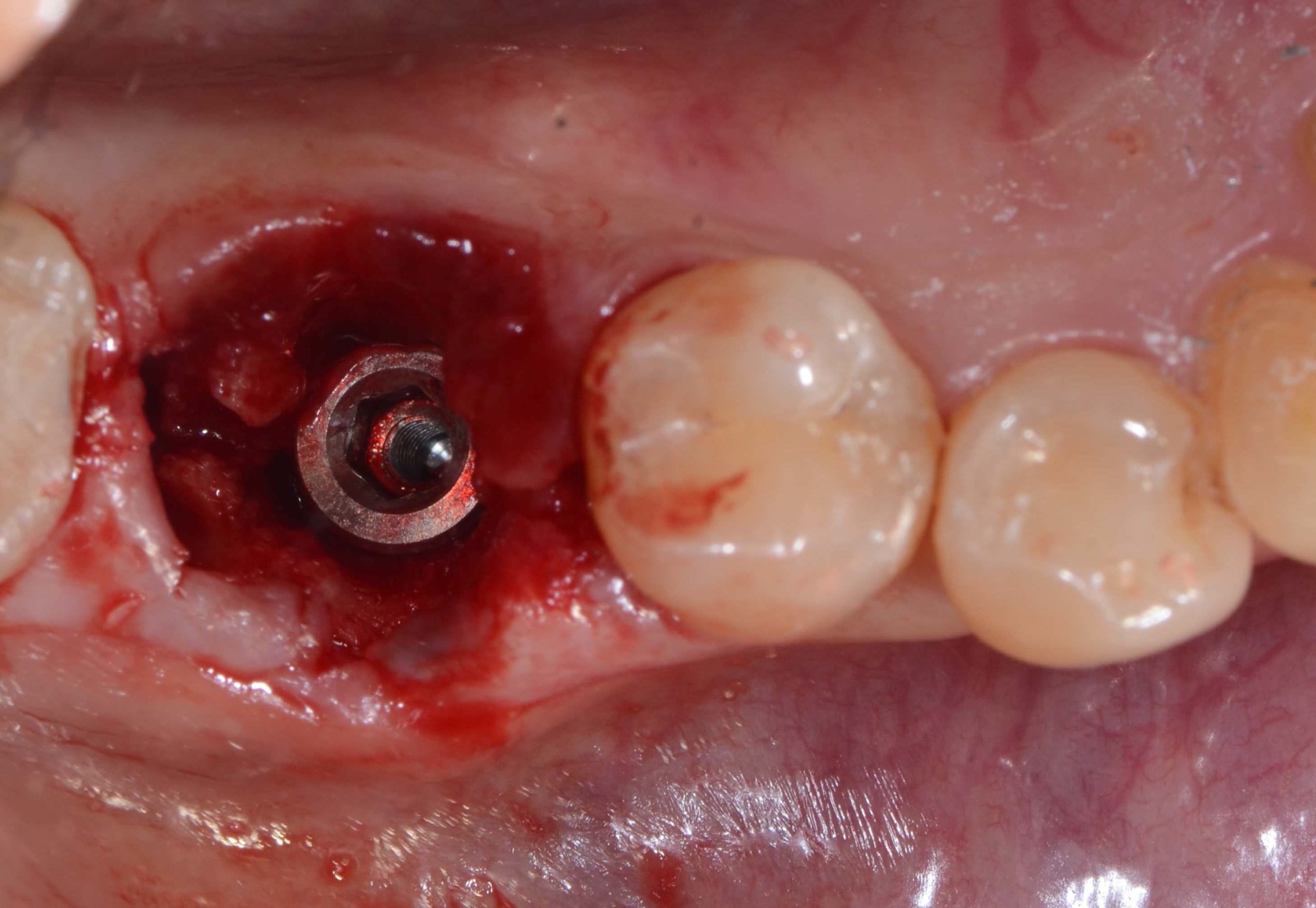 牙齒拔除後，立即植入植體並填補骨粉，術後縫合牙齦