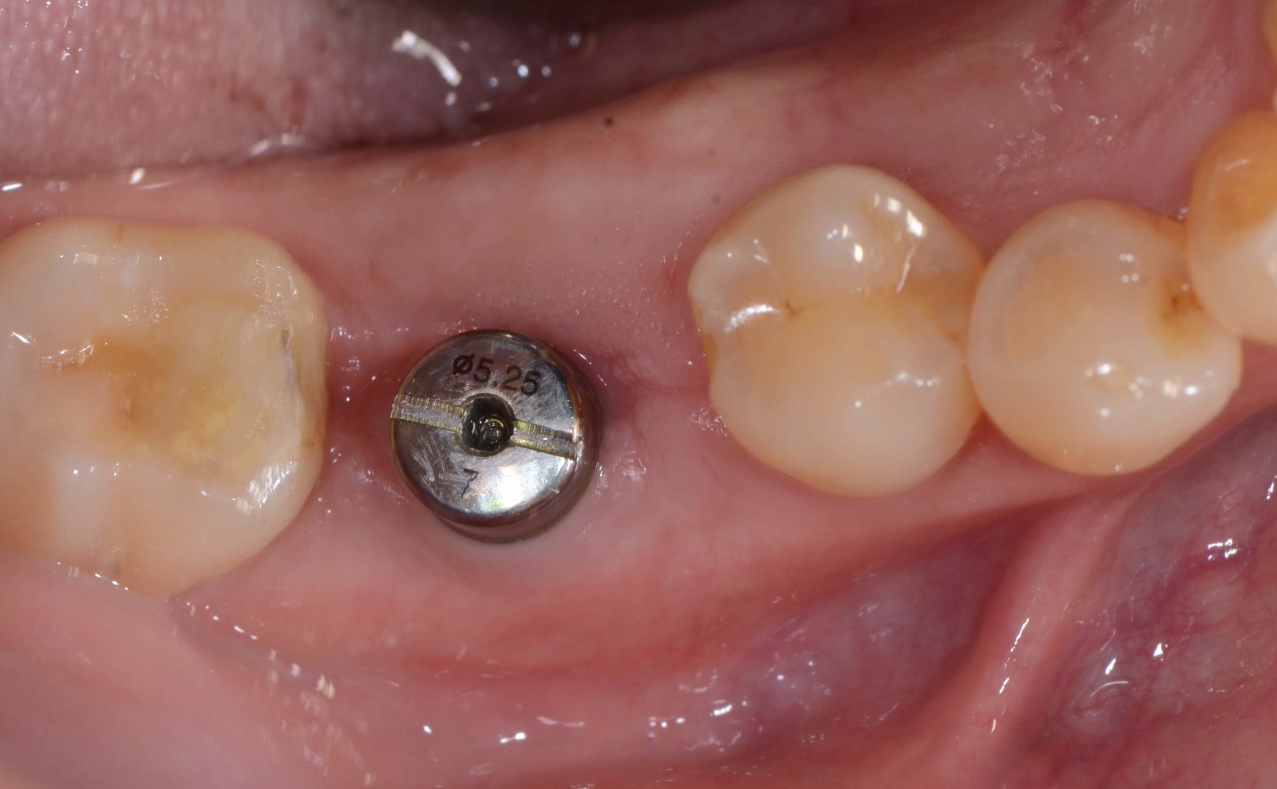 等待3-6個月骨整合完成，即可取模製作牙冠