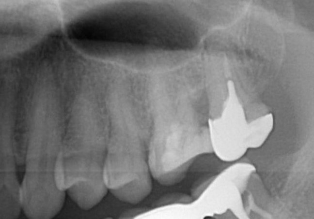 (案例一) 左上顎第一大臼齒深度蛀牙需要拔除