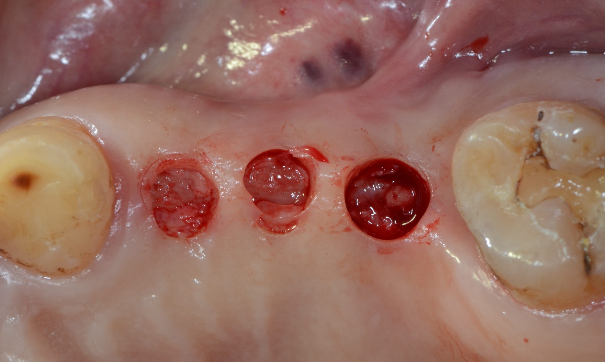 拔完牙五個月後，以不翻瓣的方式，直接在牙齦上開洞(需要有足夠寬的齒槽骨與角化牙齦)