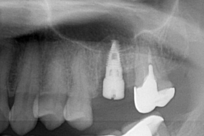 (案例一) 牙齒拔除後，立即做「鼻竇增高術」，並充填骨粉與植入植體，手術一次完成