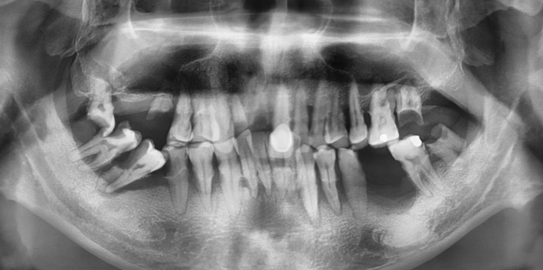 (案例二) 全口重度牙周病患者