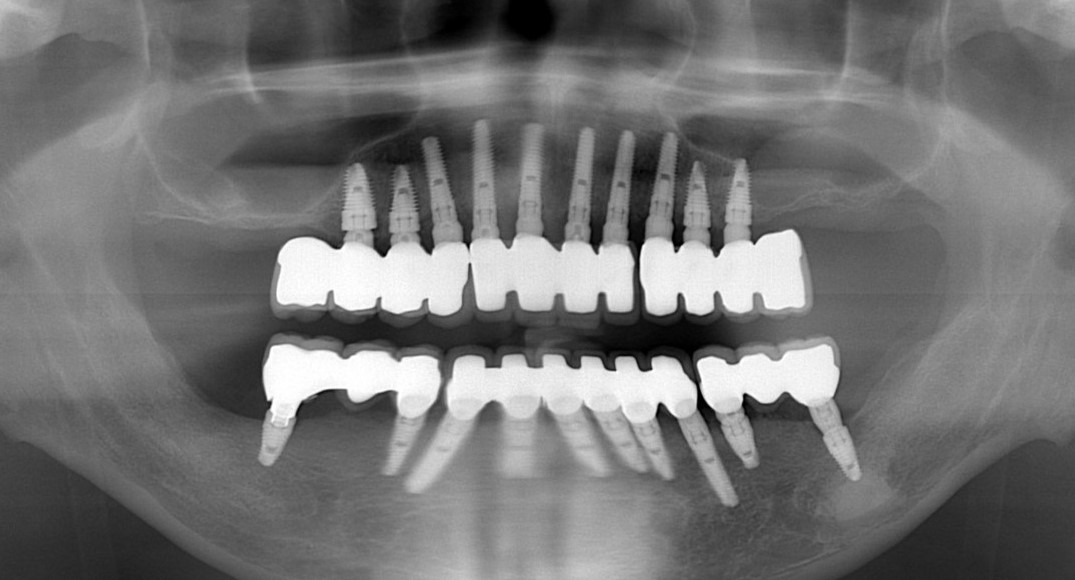(案例二) 全口植牙治療完成X光片